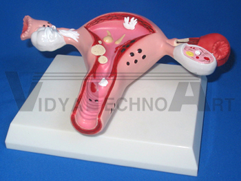 Model of pathological uterus ovary